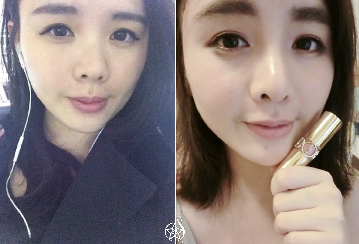 拒當複製人！自體肋軟骨隆鼻，訂製專屬自己的美鼻